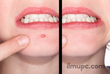 cara menghilangkan jerawat di Photoshop