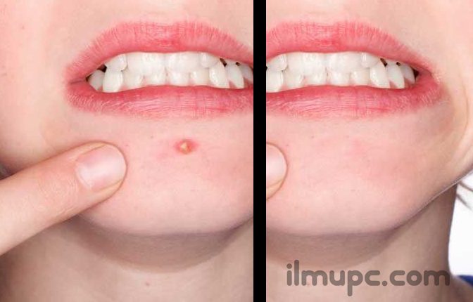 cara menghilangkan jerawat di Photoshop